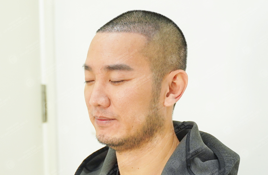 Youtuber Hùng Lâm - Cấy tóc đường chữ M 5