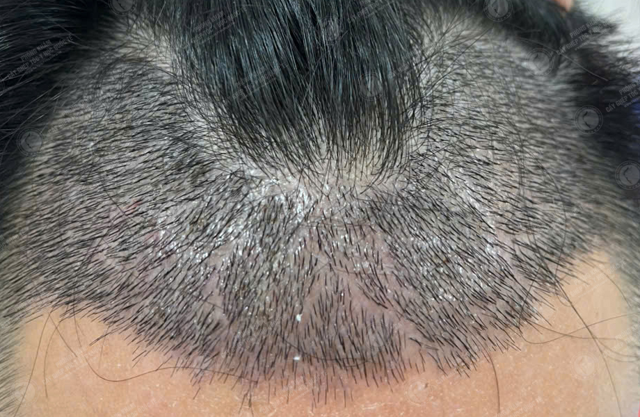 Phùng Minh Sơn - Cấy tóc đường chữ M 5