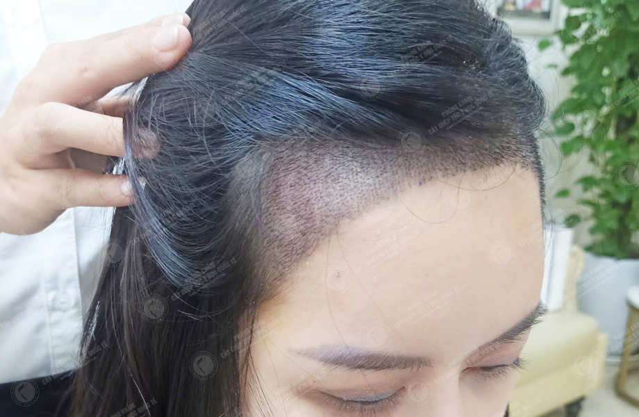 Nguyễn Quỳnh Ly - Cấy tóc đường chữ M 5