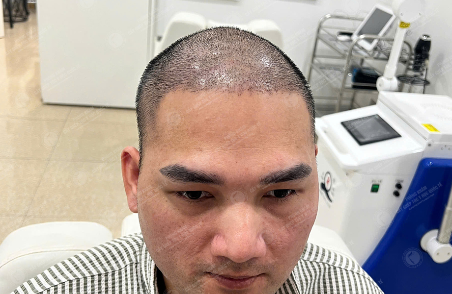 Trần Thanh Hưng - Cấy tóc đường chữ M 5