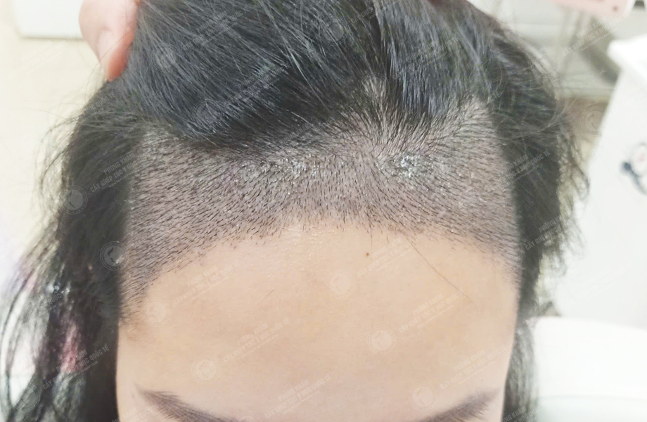 Ngô Thùy Linh - Cấy tóc đường chữ M 5