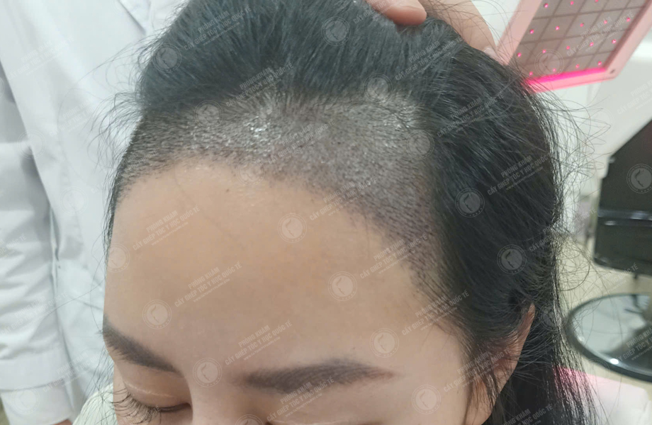 Lê Lan Anh - Cấy tóc đường chữ M 5