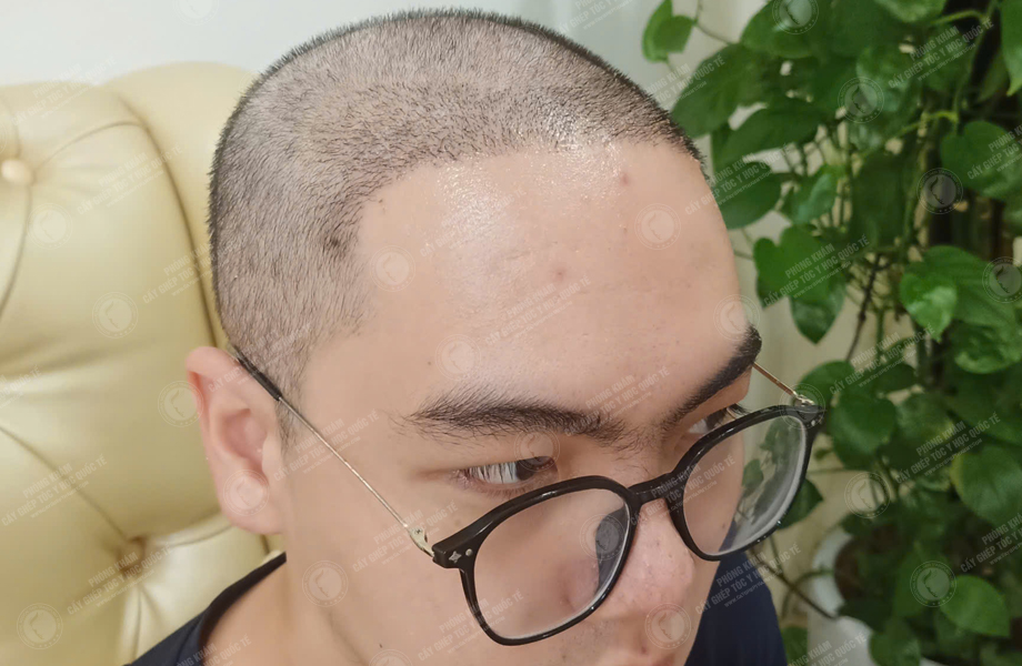 Trần Văn Đông - Cấy tóc đường chữ M 5