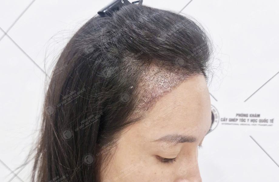 Nguyễn Thị Hồng - Cấy tóc đường chữ M 5