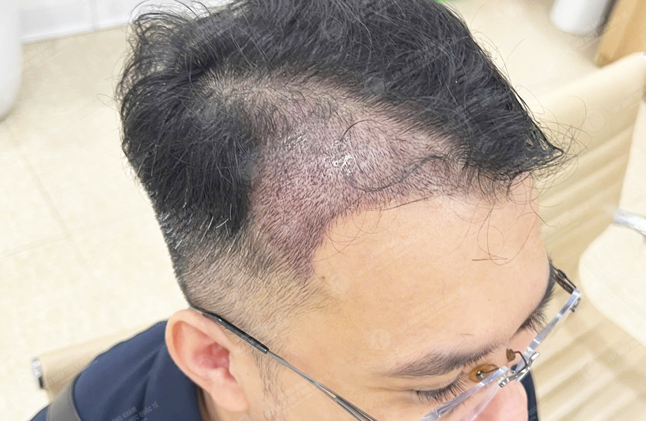 Nguyễn Thành Tiến - Cấy tóc đường chữ M 5