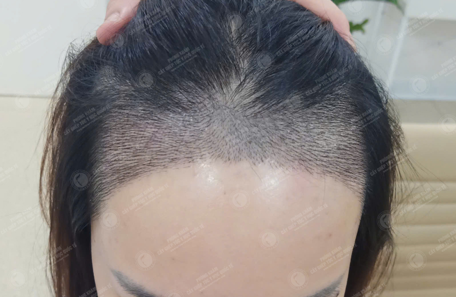 Nguyễn Hồng Ánh - Cấy tóc đường chữ M 5