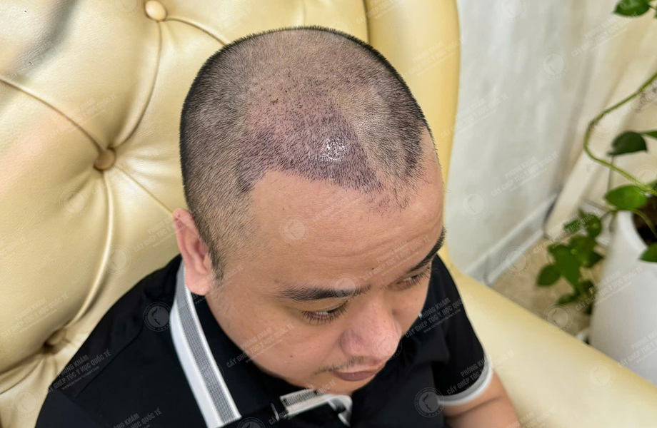 Đỗ Tùng Sơn - Cấy tóc đường chữ M 5
