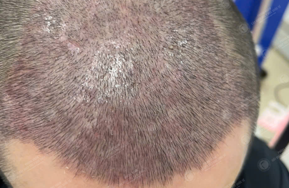 Trần Ngọc Thanh - Cấy tóc đường chữ M 5