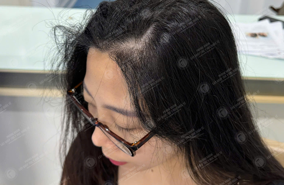 Lê Thị Lý - Cấy tóc đường chữ M 5