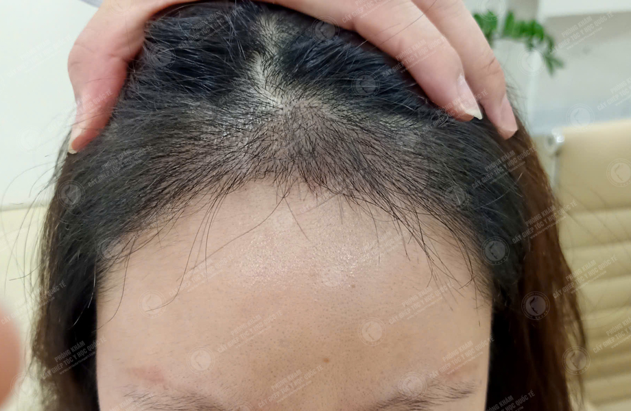 Trần Hồng Nhung - Cấy tóc đường chữ M 5