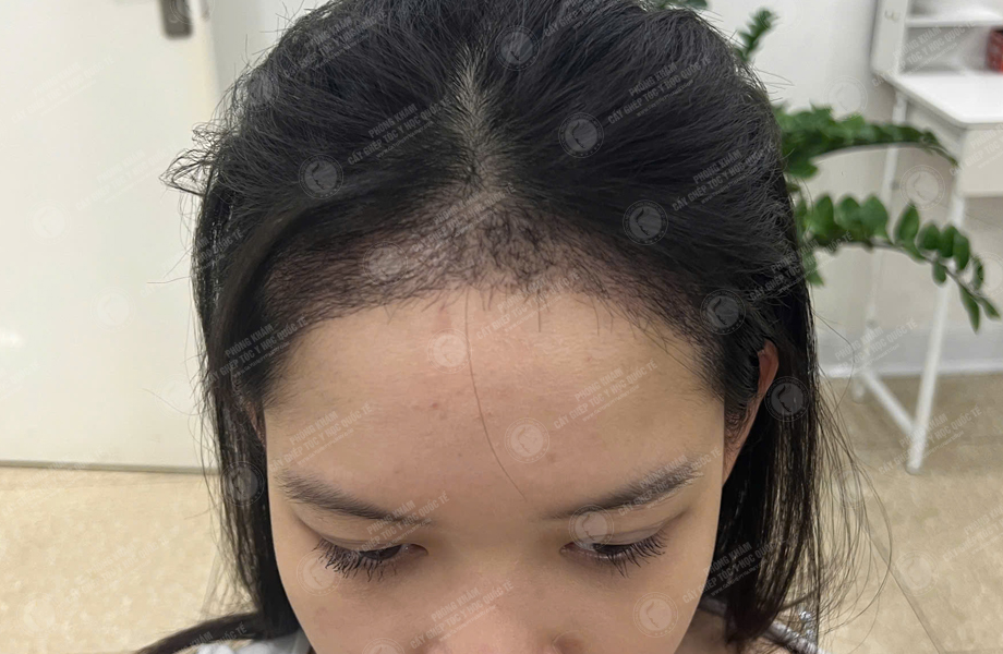 Nguyễn Hồng Ngọc - Cấy tóc đường chữ M 6
