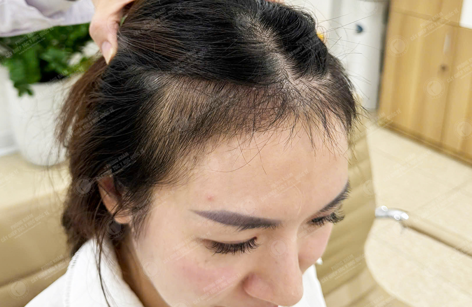 Ngô Thùy Dung - Cấy tóc đường chữ M 6