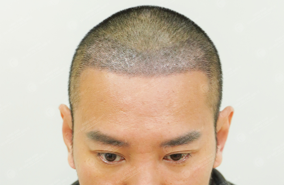 Youtuber Hùng Lâm - Cấy tóc đường chữ M 6