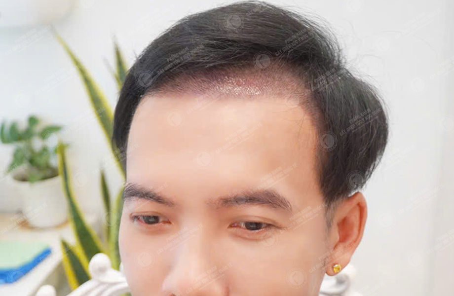 Ca sĩ Phạm Trưởng - Cấy tóc đường chữ M 6
