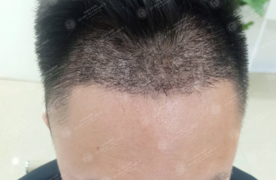 Phùng Minh Sơn - Cấy tóc đường chữ M 6