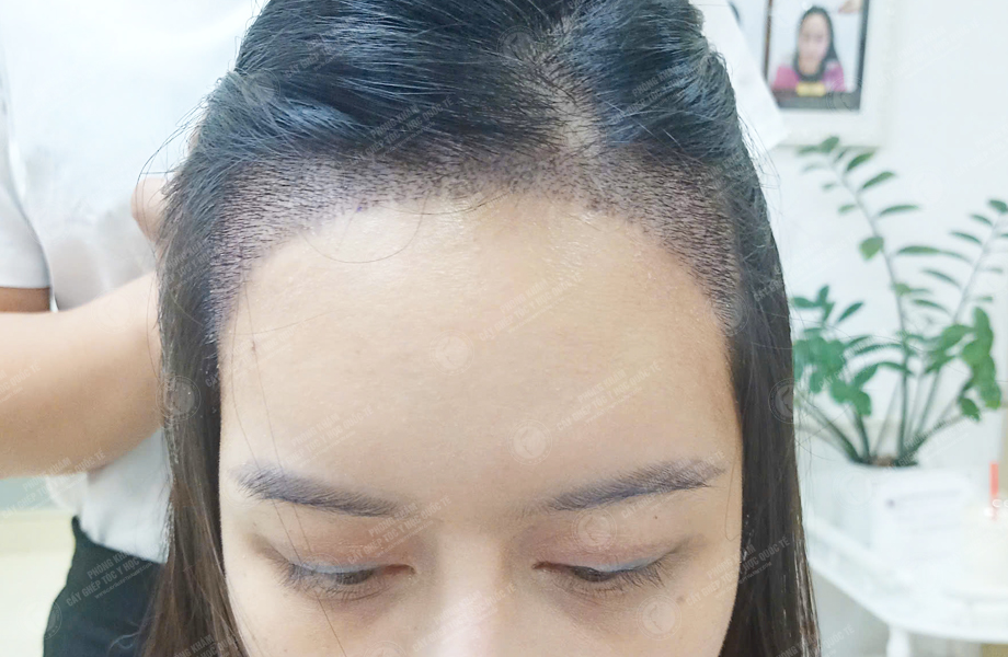 Nguyễn Quỳnh Ly - Cấy tóc đường chữ M 6