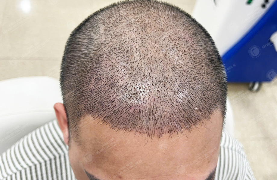 Trần Thanh Hưng - Cấy tóc đường chữ M 6