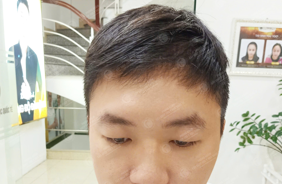 Chih Cheng - Cấy tóc đường chữ M 6