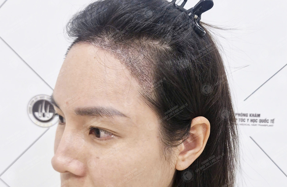 Nguyễn Thị Hồng - Cấy tóc đường chữ M 6