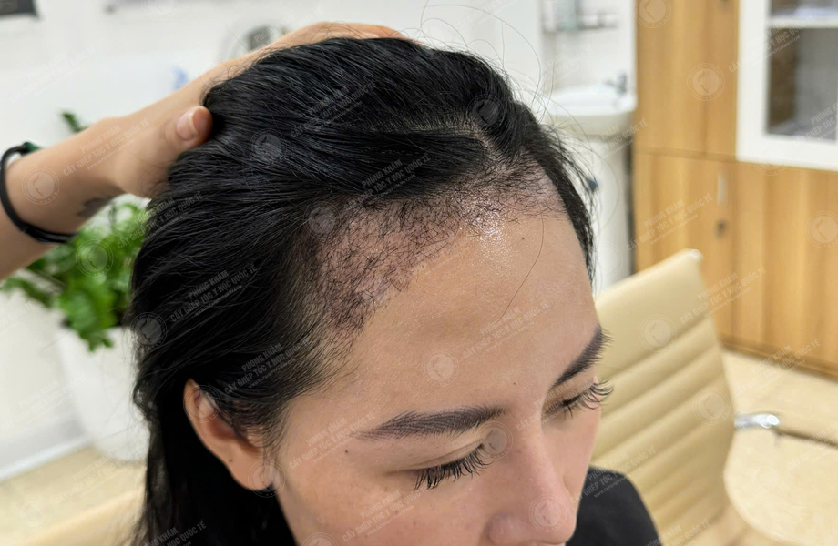 Lê Lan Anh - Cấy tóc đường chữ M 6