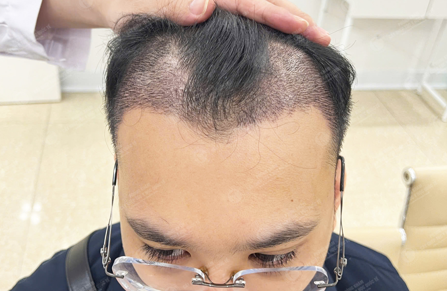 Nguyễn Thành Tiến - Cấy tóc đường chữ M 6