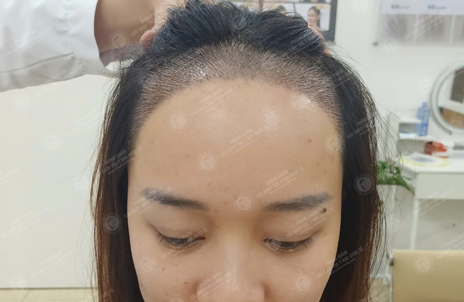 Nguyễn Hồng Ánh - Cấy tóc đường chữ M 6