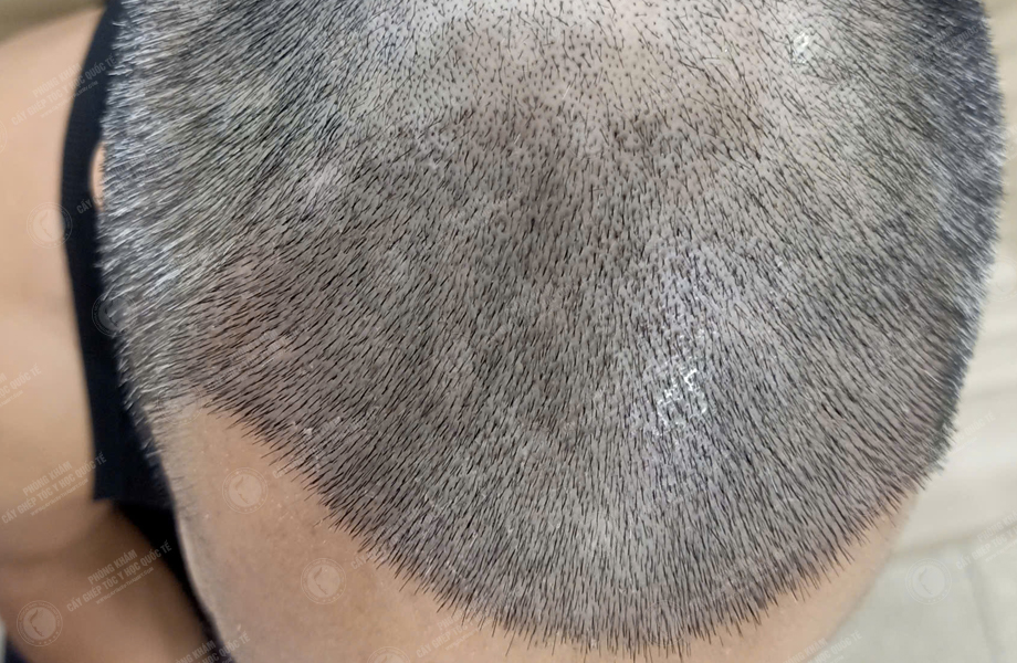 Lý Hùng Mạnh - Cấy tóc đường chữ M 6