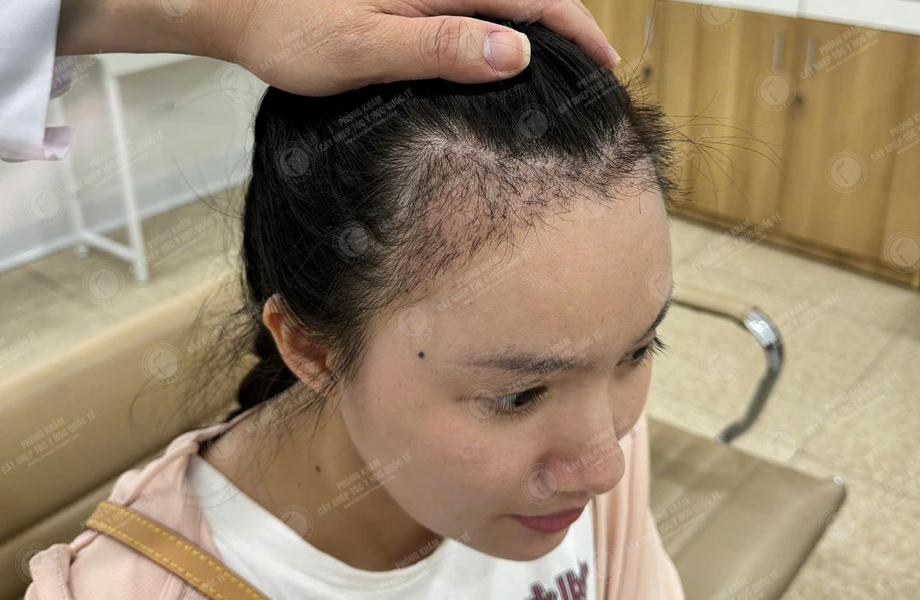 Trần Thị Mận - Cấy tóc đường chữ M 6