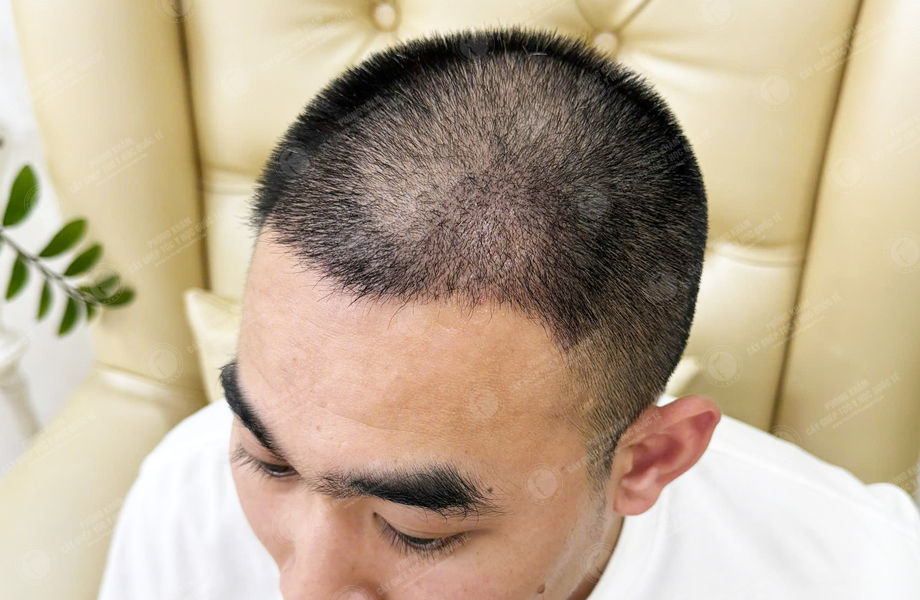 Nguyễn Hoàng Trung - Cấy tóc đường chữ M 6