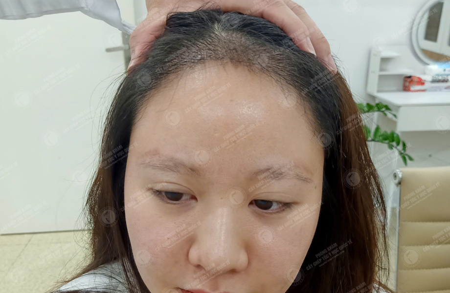 Trần Hồng Nhung - Cấy tóc đường chữ M 6