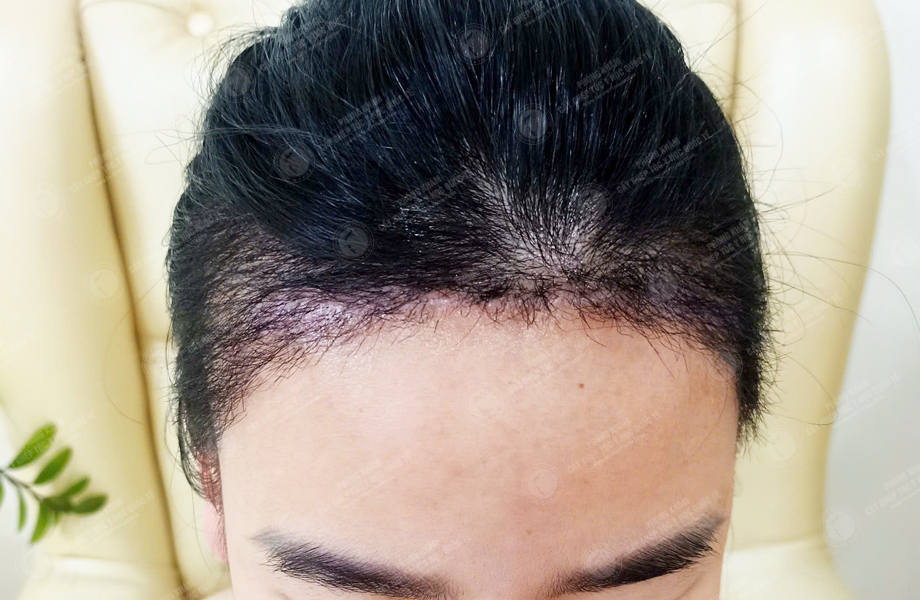 Ngô Thanh Lan - Cấy tóc đường chữ M 7
