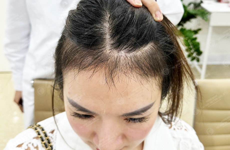 Ngô Thùy Dung - Cấy tóc đường chữ M 7