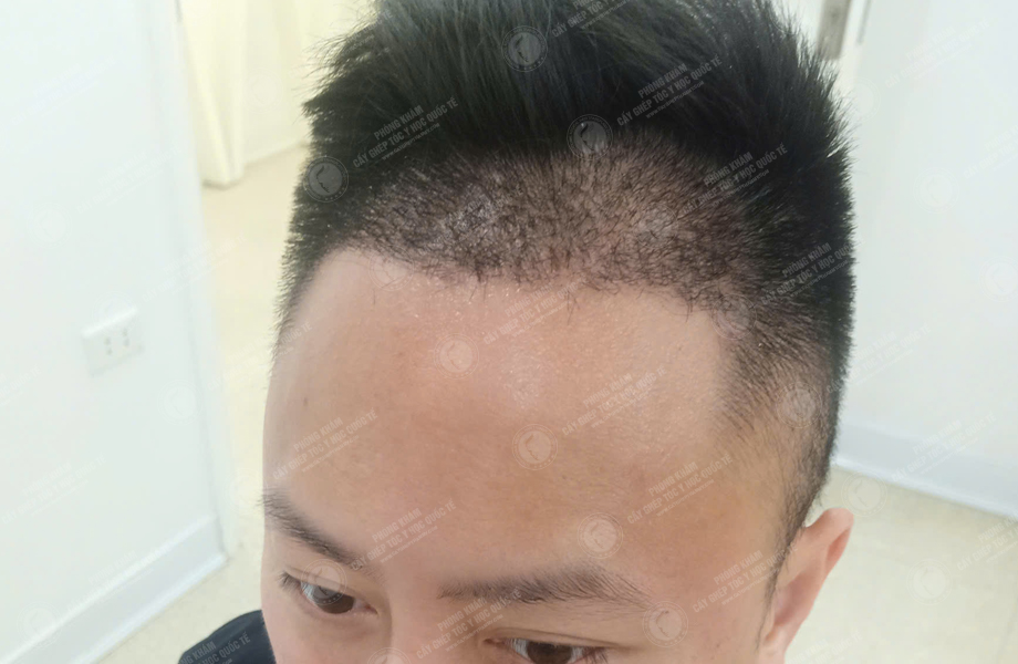 Phùng Minh Sơn - Cấy tóc đường chữ M 7
