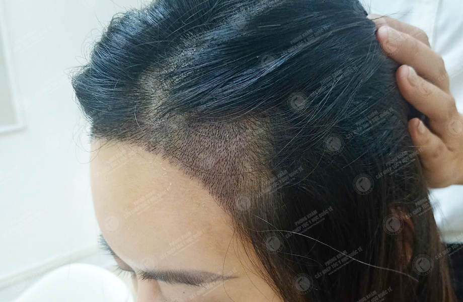 Nguyễn Quỳnh Ly - Cấy tóc đường chữ M 7