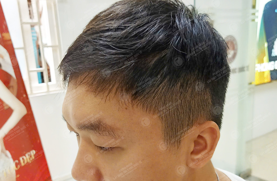 Chih Cheng - Cấy tóc đường chữ M 7