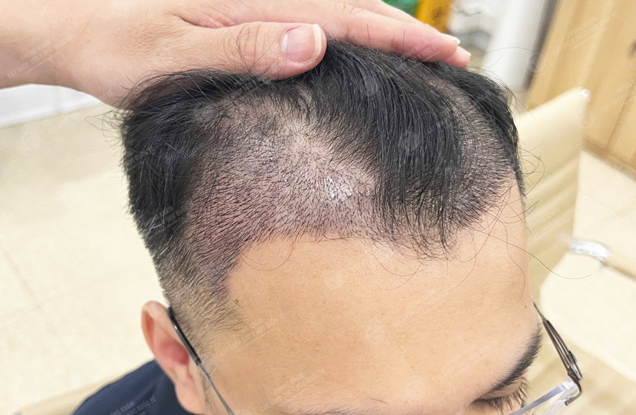 Nguyễn Thành Tiến - Cấy tóc đường chữ M 7