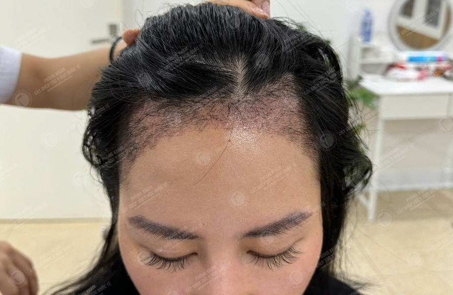 Lê Lan Anh - Cấy tóc đường chữ M 7