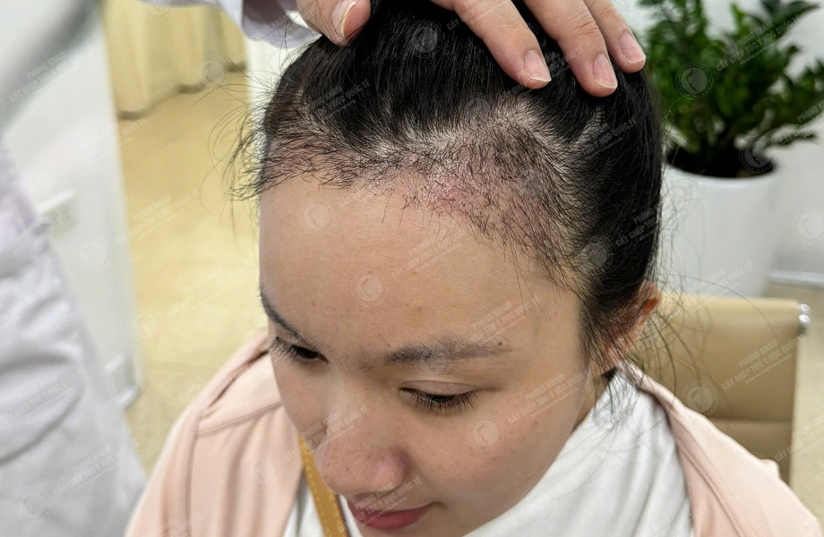 Trần Thị Mận - Cấy tóc đường chữ M 7