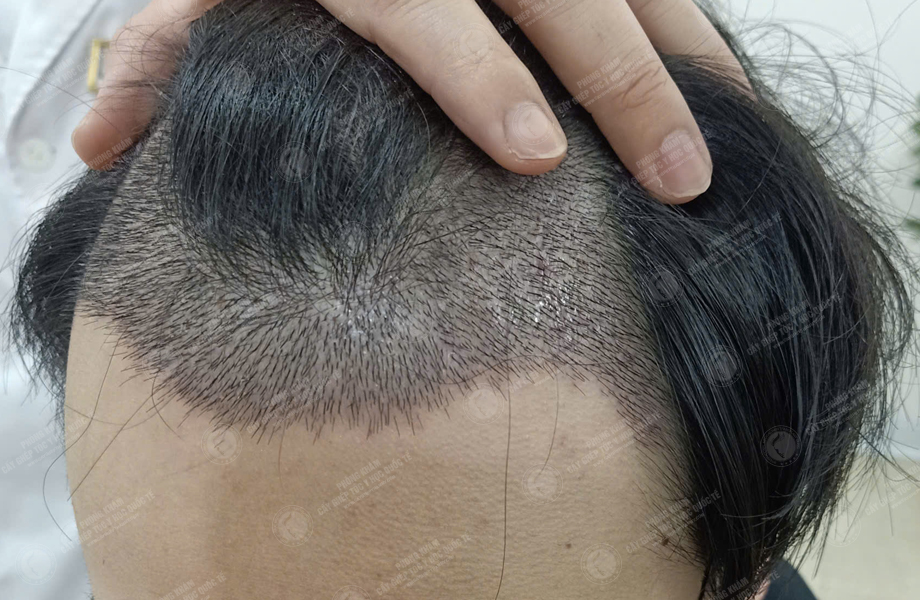 Phạm Tuấn Hùng - Cấy tóc đường chữ M 7