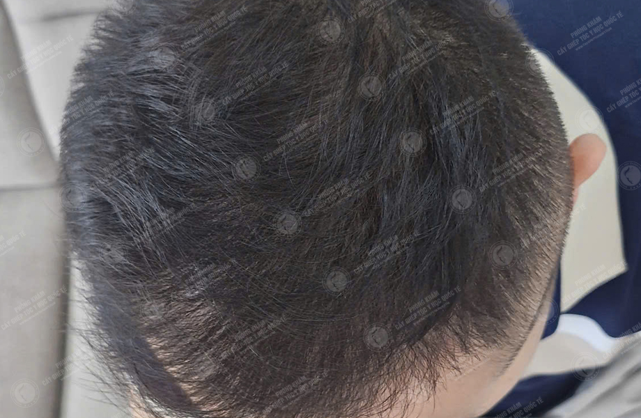 Trần Ngọc Thanh - Cấy tóc đường chữ M 7