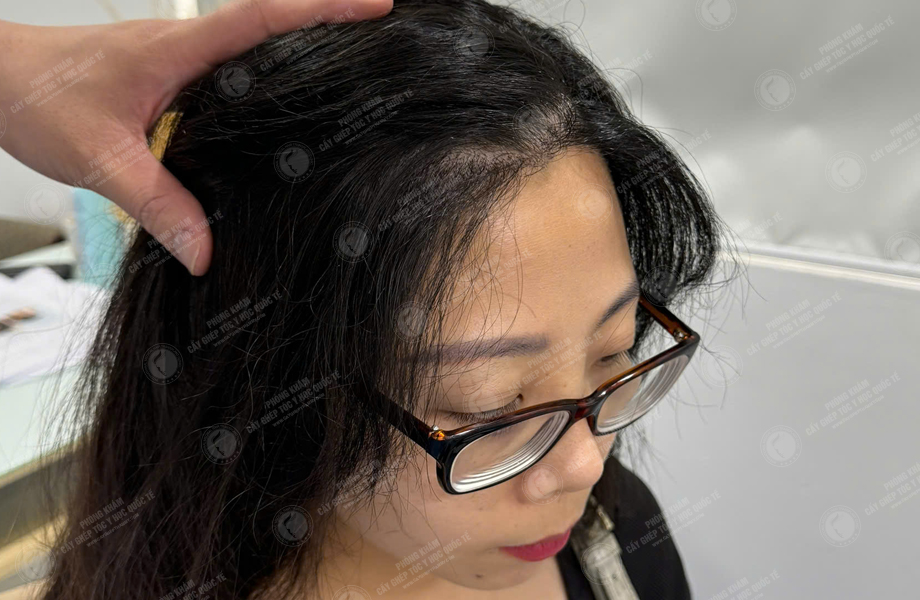 Lê Thị Lý - Cấy tóc đường chữ M 7