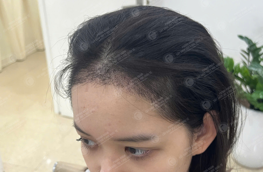 Nguyễn Hồng Ngọc - Cấy tóc đường chữ M 7