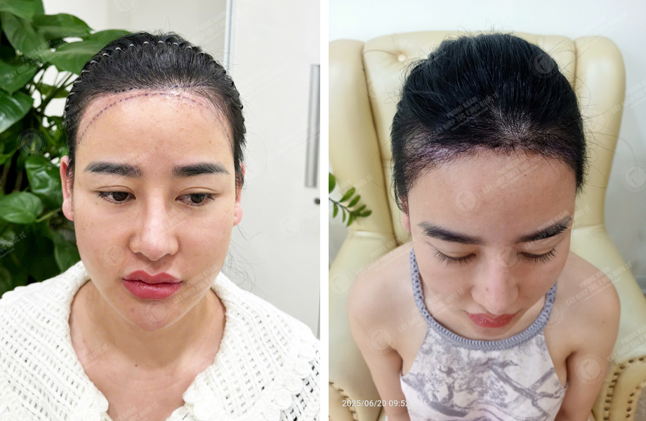  Ngô Thanh Lan - Cấy tóc đường chữ M 1