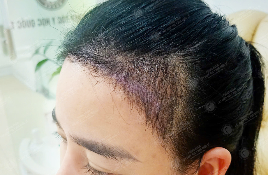 Ngô Thanh Lan - Cấy tóc đường chữ M 8