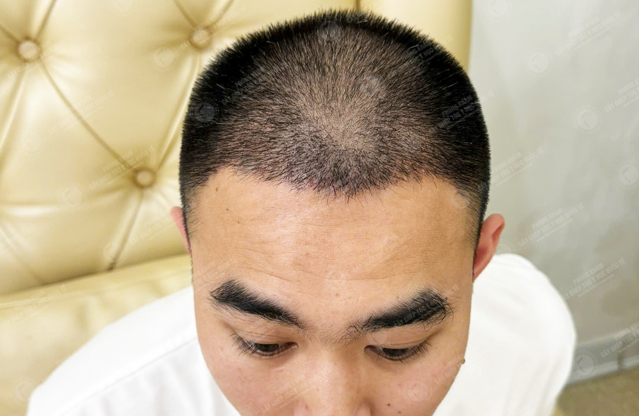 Nguyễn Hoàng Trung - Cấy tóc đường chữ M 8