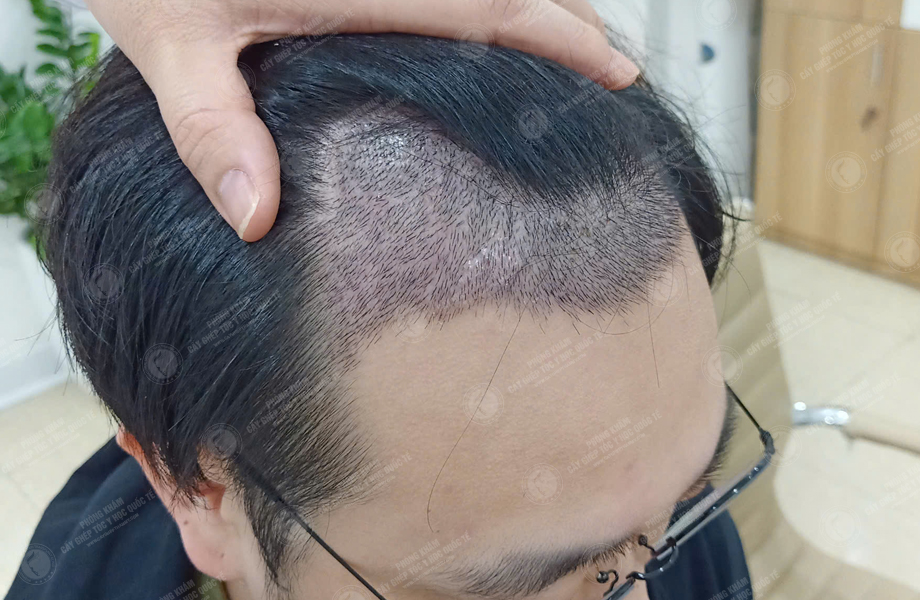 Phạm Tuấn Hùng - Cấy tóc đường chữ M 8