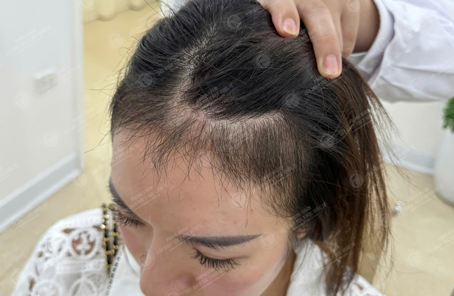 Ngô Thùy Dung - Cấy tóc đường chữ M 8