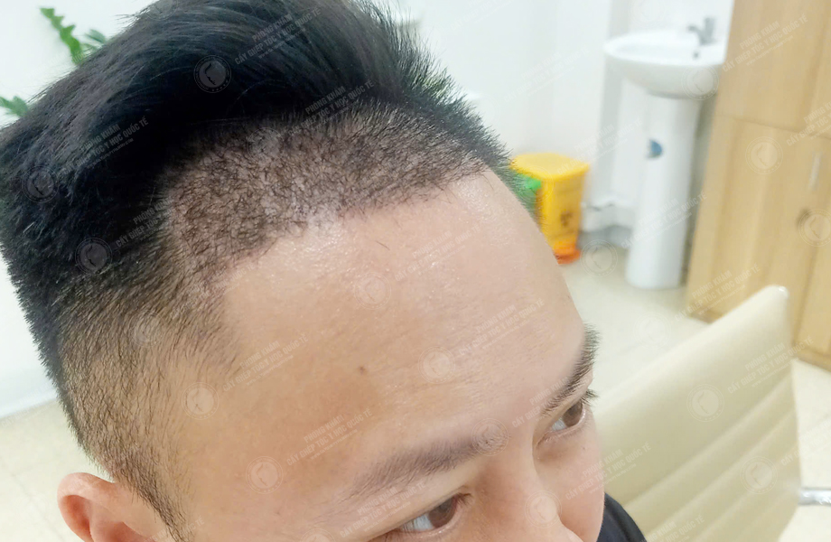 Phùng Minh Sơn - Cấy tóc đường chữ M 8