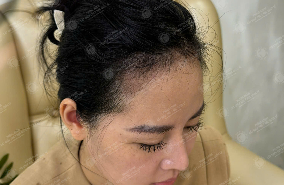 Lê Lan Anh - Cấy tóc đường chữ M 9