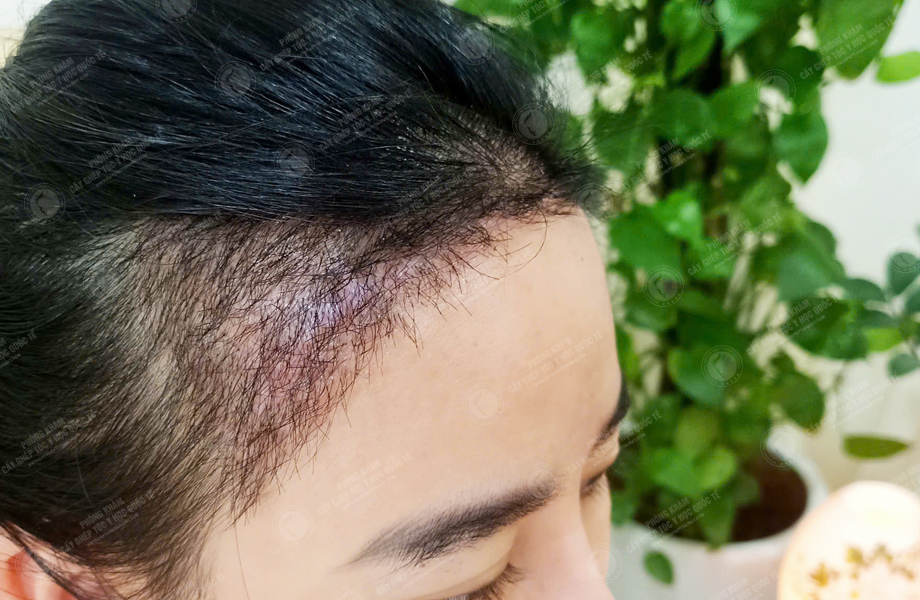 Ngô Thanh Lan - Cấy tóc đường chữ M 9